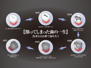 削る治療が歯の寿命を縮める