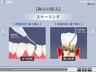 歯石を取るべき理由