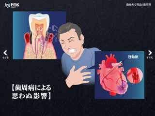 歯をなくす理由／歯周病