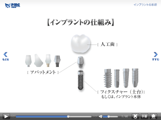 インプラントの基礎