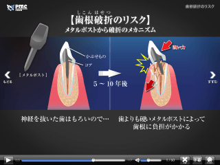 歯根破折のリスク