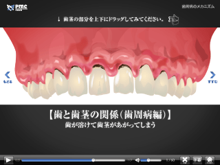 歯周病のメカニズム