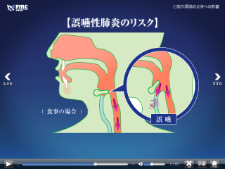 誤嚥性肺炎のリスク