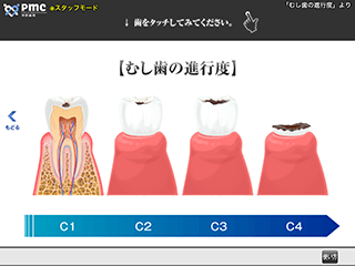 むし歯の進行度